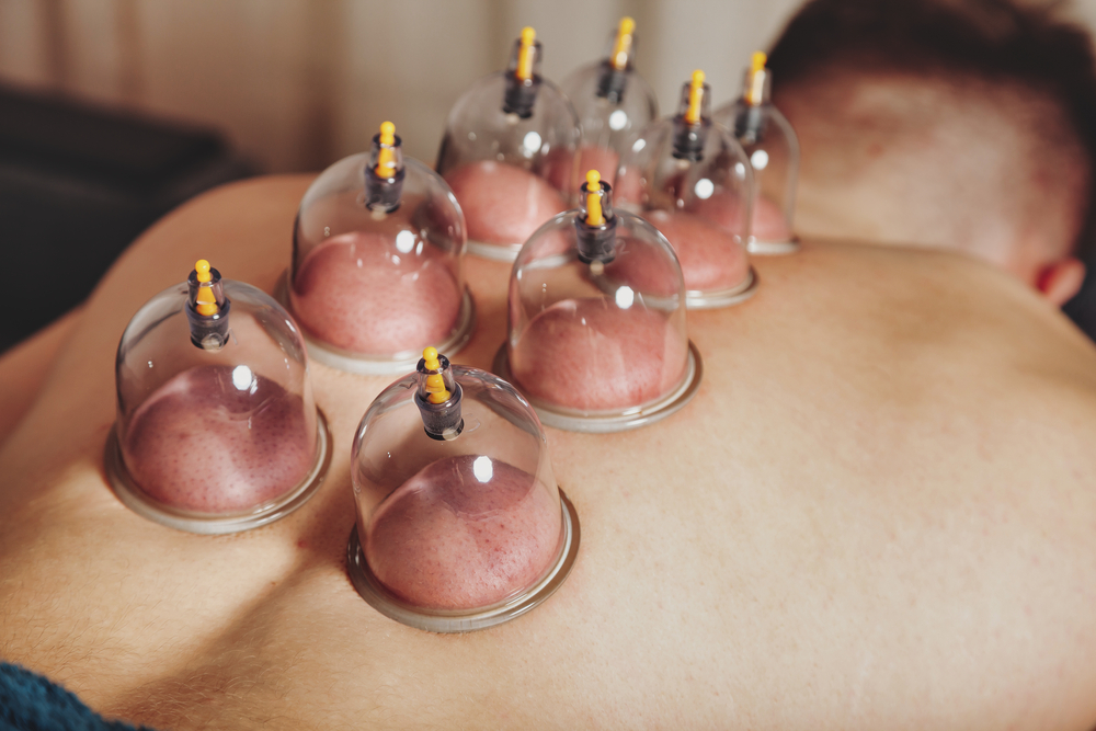 Hijama (Cupping Therapy & Dry Needling)